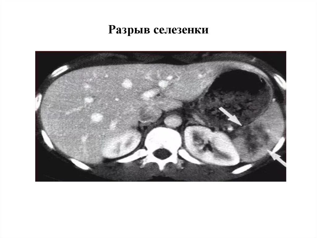 Слабости селезенки. Подкапсульный разрыв печени кт. Подкапсульный разрыв селезенки кт. Субкапсулярная гематома селезенки кт. Субкапсулярная гематома селезенки мрт.