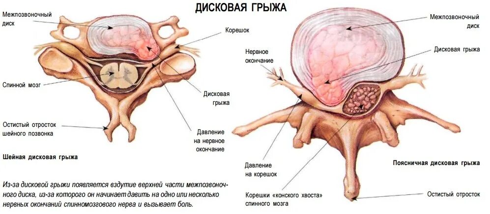 Медианно парамедианная протрузия диска. Медианно-парамедианная билатеральная грыжа диска l5-s1. фораминально-парамедианная грыжа. латерально фораминальная грыжа. дорзальная медианная грыжа.