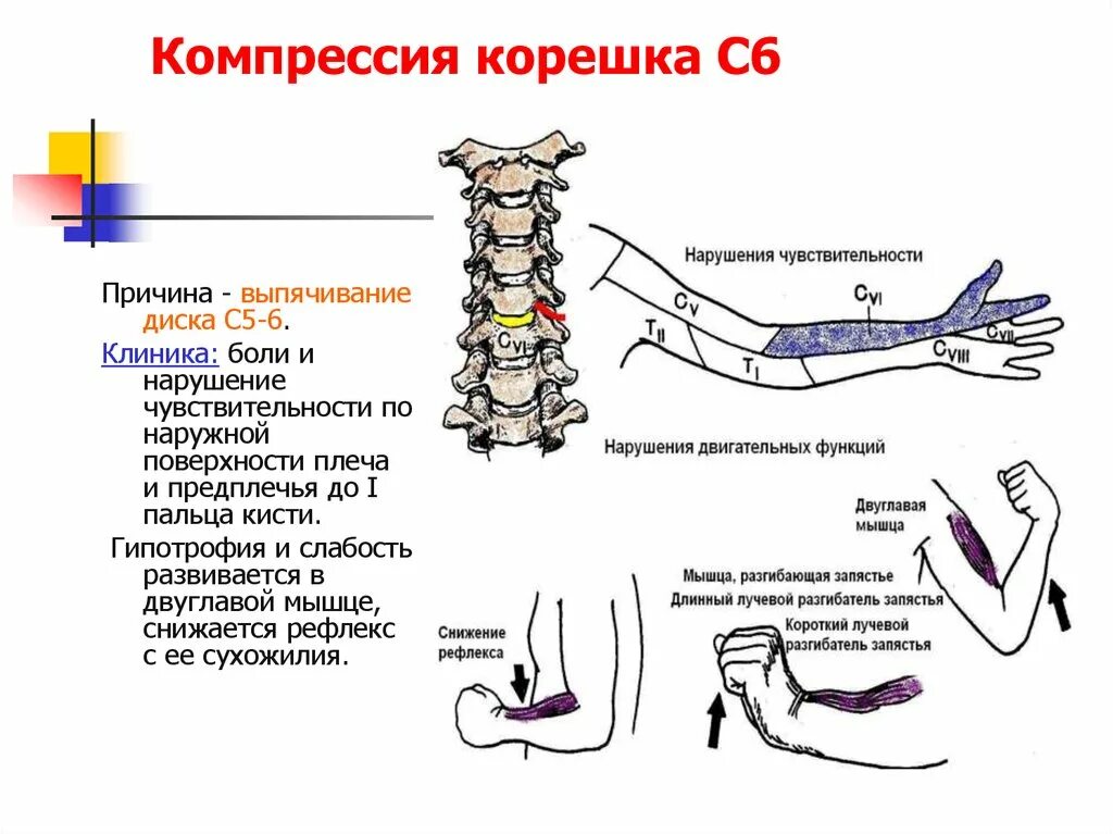 Корешковое поражение. Компрессия s1 корешка симптомы. Компрессия корешка с5. Компрессия корешка l4 l5. Корешковый синдром с6.