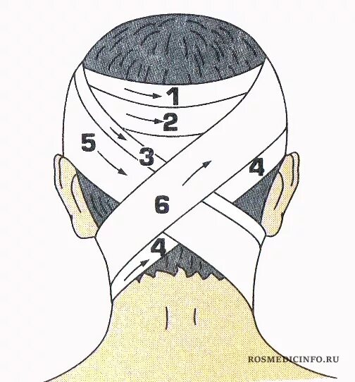 Техника наложения крестообразной повязки. Крестообразная (восьмиобразная) повязка. Крестообразная ( восьмиобразная) повязка техника. Восьмиобразная повязка техника наложения. Наложение крестообразной повязки на затылок.