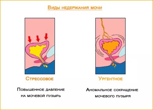 Почему подтекает моча у женщин. Типы стрессового недержания мочи. мочевое недержание. недержание мочи у женщин после родов упражнения. типы недержания мочи у женщин.