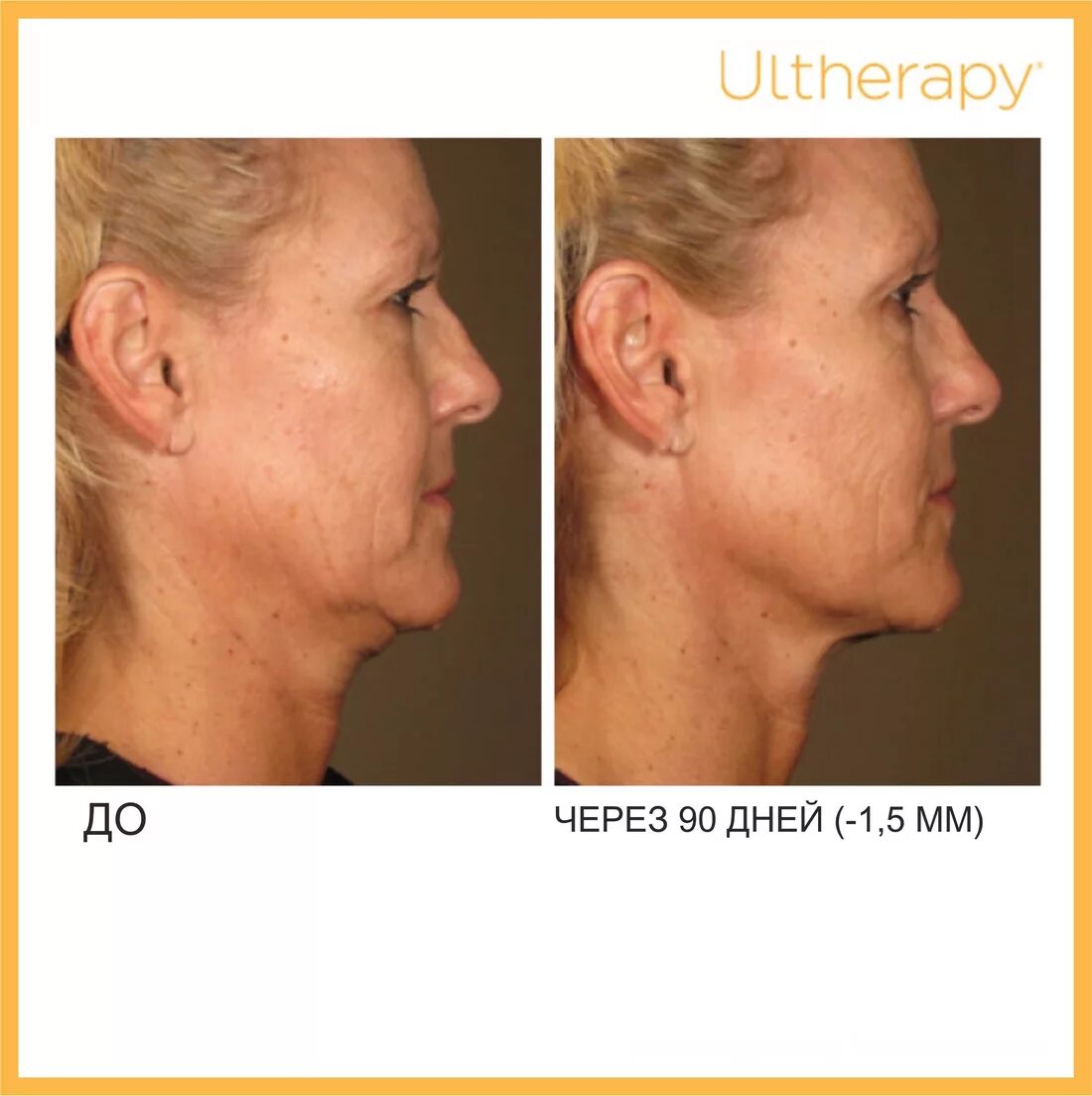 Подтяжка лица пластика. Чесалин иван павлович пластический хирург. Подтяжка лица отрицательные отзывы. Подтяжка лица отрицательные отзывы. Пластика нижней трети лица.