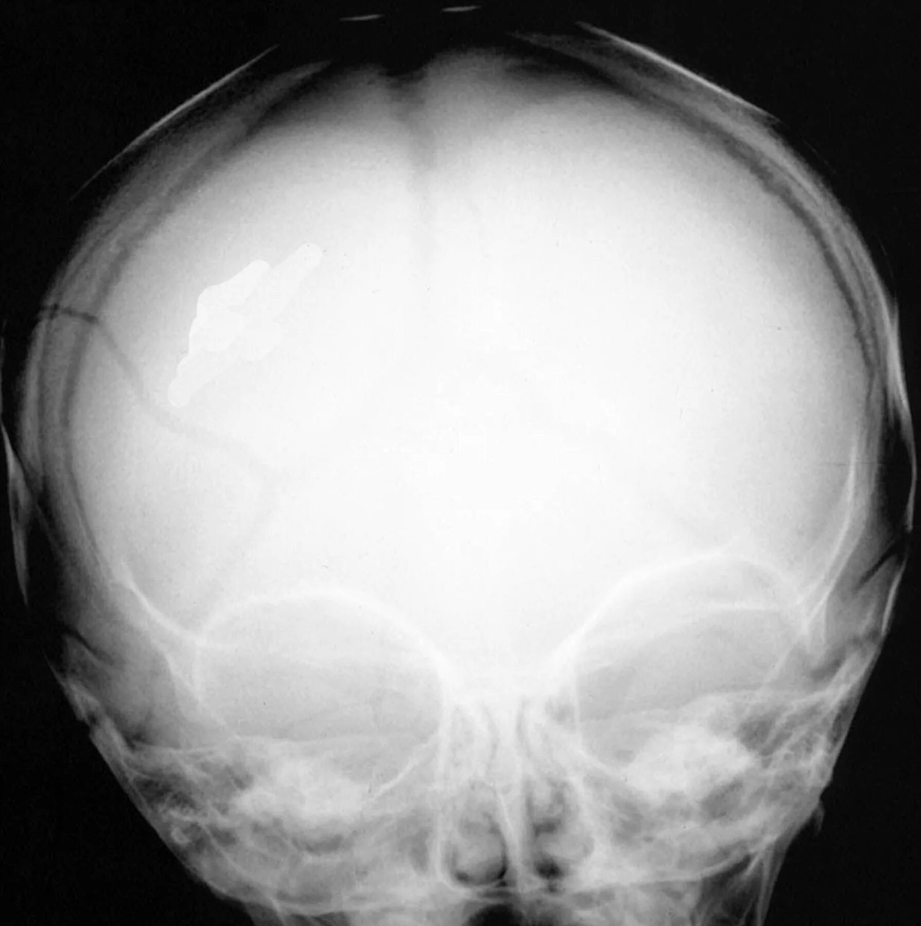 Вдавленный перелом костей черепа рентген. Оскольчатый перелом черепа рентген. Перелом теменной кости у грудничка. Вдавленный перелом костей свода черепа рентген. Трещина черепа у ребенка