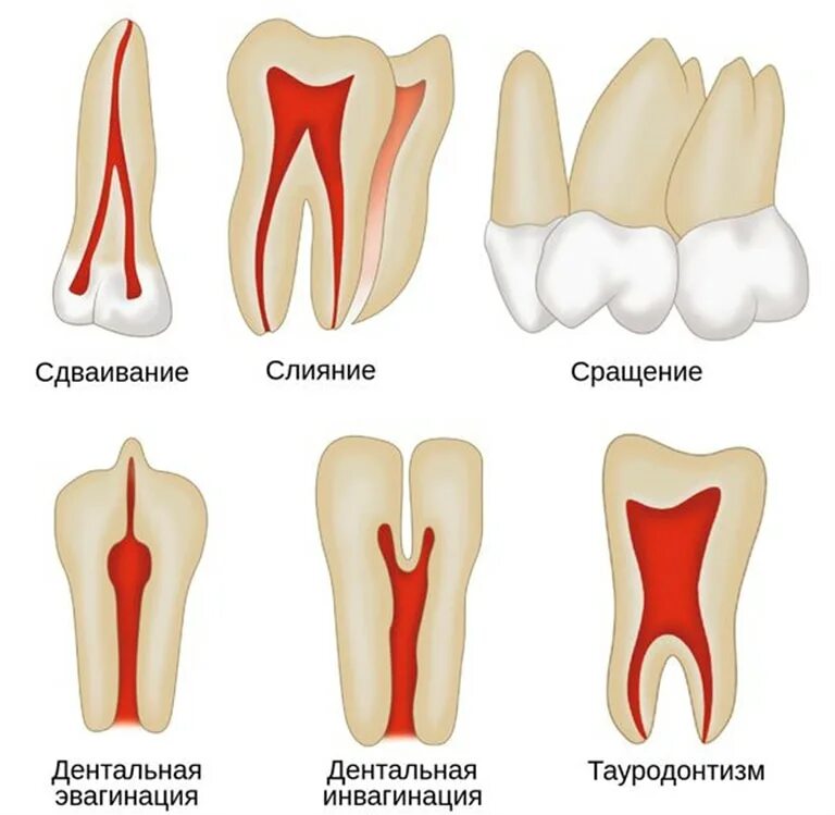 Почему зубы отличаются между собой. Аномалии строения зуба. Аномалии формы зубов - зубы Фурнье, Пфлюгера. Зубы Гетчинсона Фурнье Пфлюгера.