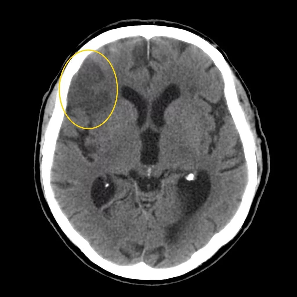 Мрт при инсульте головного мозга. Кт ГМ геморрагический инсульт. Снимки кт ишемический инсульт. Ишемический инсульт кт картина. Ишемический инсульт на кт головного мозга.