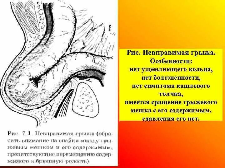 Ответы ущемленная грыжа. Ущемление паховой грыжи. Ущемленная паховая грыжа. Ущемление паховой грыжи рентген. Ущемленная пупочная грыжа.