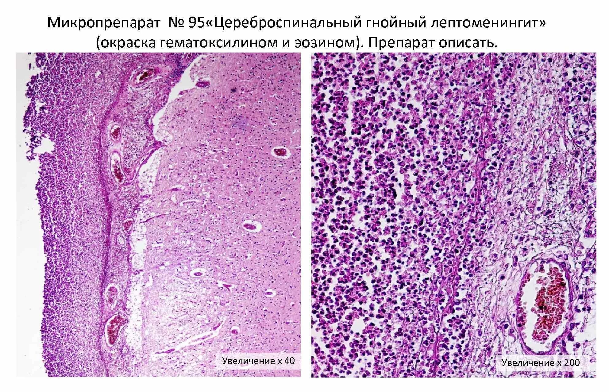 Гнойный лептоменингит (окраска гематоксилином-эозином).. Цереброспинальный Гнойный менингит макропрепарат. Гнойный менингит гистология. Эмболический Гнойный нефрит микропрепарат. Серозно гнойный менингит