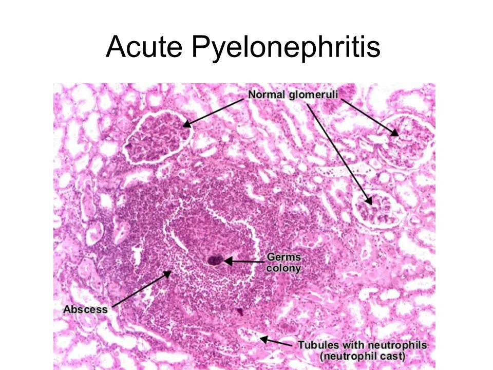 Острый гнойный пиелонефрит. Острый абсцесс почки микропрепарат. Метастатические абсцессы почки микропрепарат. Хронический абсцесс легкого микропрепарат. Метастатический абсцесс легкого микропрепарат.