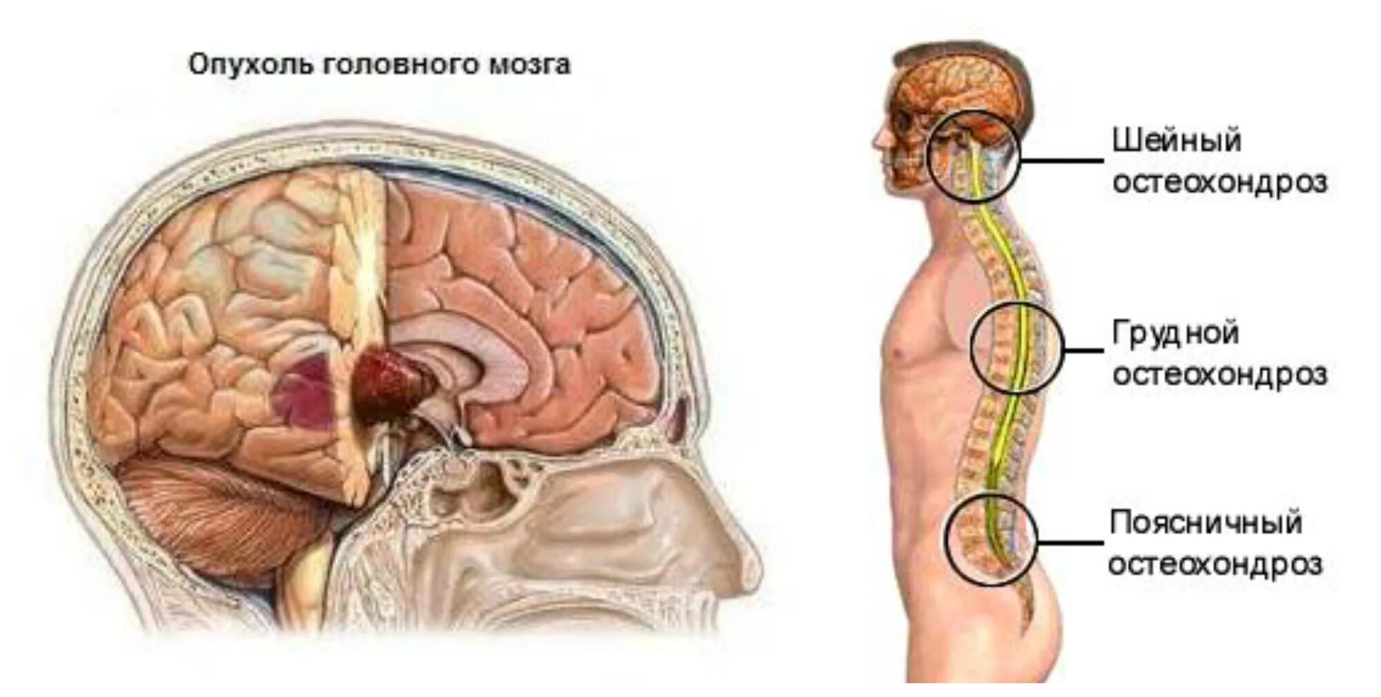 Опкхолльлголовного мозга. Новообразование в головном мозге. Объемное образование головного мозга. Лечение рака головного мозга