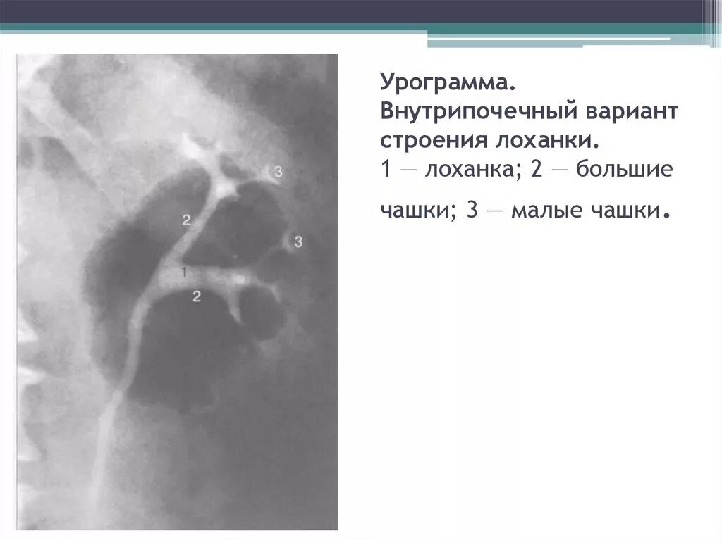 Варианты строения лоханки. Внутрипочечный Тип лоханки. Рентген, чашечки, лоханки. Анатомия почки рентген.