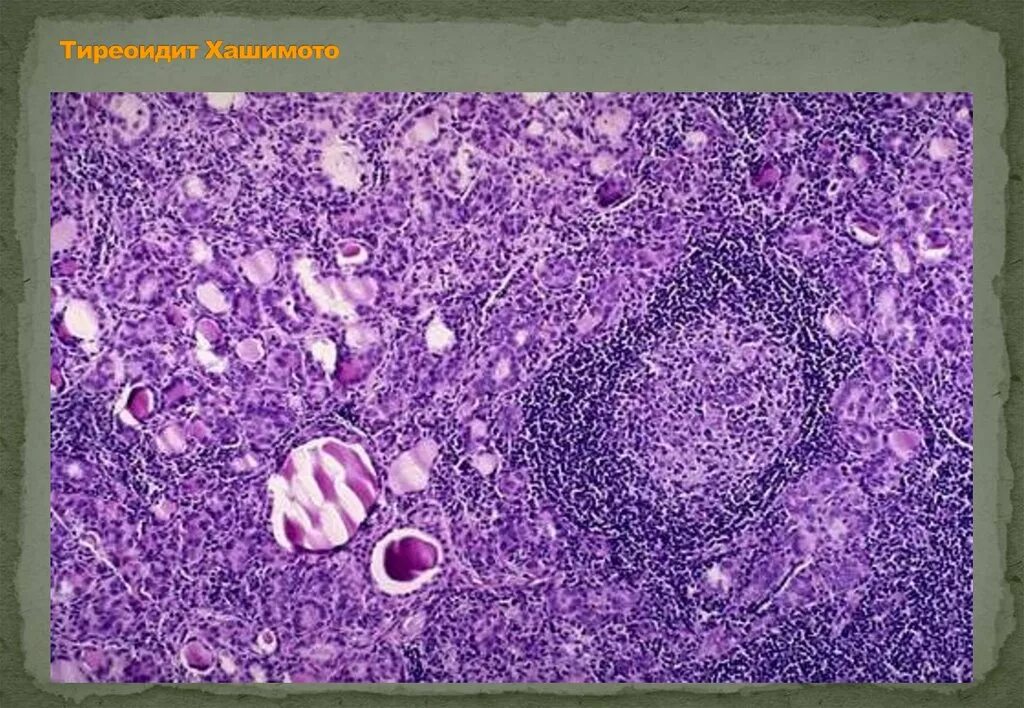 Струма Хашимото патанатомия. Тиреоидит Хашимото гистология. Аутоиммунный тиреоидит Хашимото микропрепарат патанатомия. Аутоиммунный тиреоидит Хашимото микропрепарат. Лимфоцитарный тиреоидит