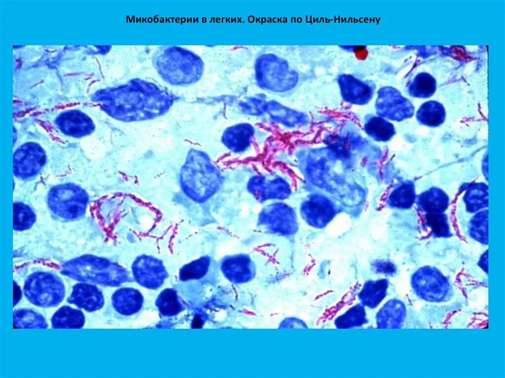 Туберкулез циль нильсену. Туберкулез окраска по Цилю-Нильсену. Микобактерии Циль Нильсен. Микобактерии туберкулеза Циль Нильсен. Окраска микобактерий по Цилю-Нильсену микобактерии.
