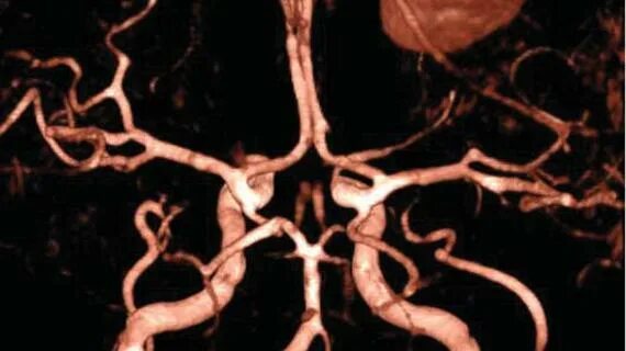 Виллизиев круг болезнь. Трифуркация Виллизиева круга. Виллизиев круг мрт.