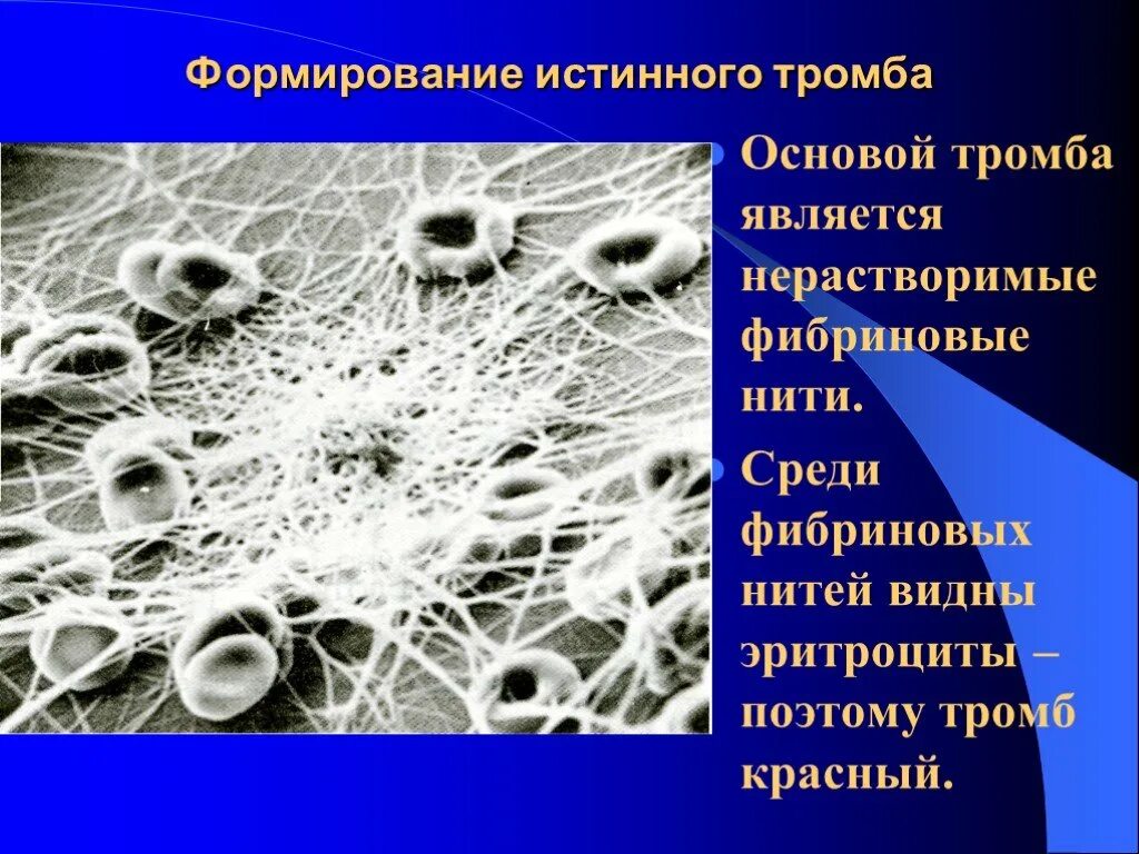 Что является тромба. Что является основой тромба. основу тромба составляет. чо является основной тромба.