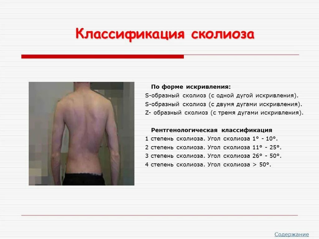 Сколиоз 2 степени это. Z образный сколиоз 4 степени. Классификация сколиоза 4 степень. С образное искривление позвоночника. S образное искривление позвоночника 1 степени.