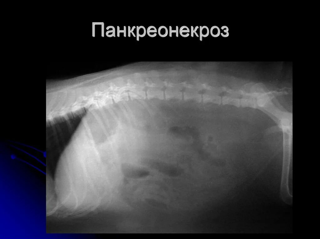 Что такое некроз поджелудочной железы у мужчин. Геморрагический панкреонекроз поджелудочной. Жировой панкреонекроз. Очаги жирового некроза поджелудочной. Панкреатический некроз поджелудочной.