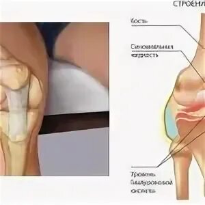 Уколы в тазобедренный сустав гиалуроновой кислоты отзывы