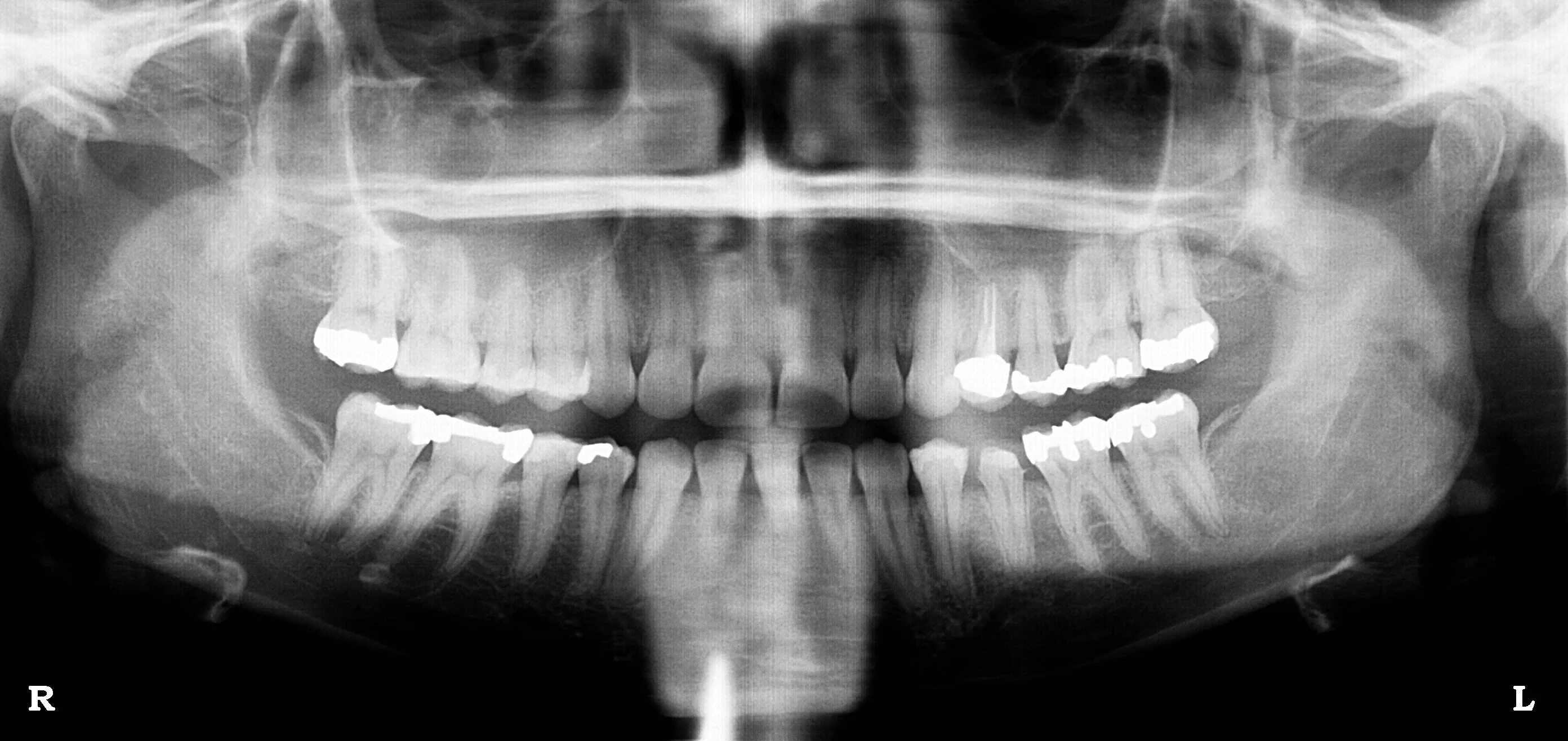 Ложный сустав челюсти рентгенограмма. Рентген челюстно лицевой. Ложный сустав нижней челюсти на рентгене. Панорамный снимок зубов.