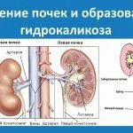 Каликоэктазия правой почки. Признаки каликоэктазии почек. Основные симптомы нефролитиаза. Признаки каликоэктазии почек. Парапельвикальные кисты мрт.