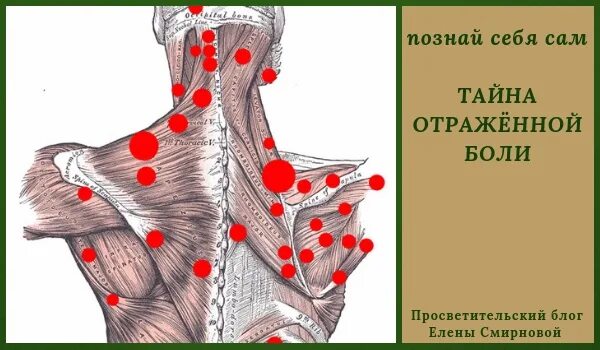 Триггерные точки шейный остеохондроз. Триггерные точки схема атлас. Клинический атлас триггерных точек | бил эндрю. Клинический атлас триггерных точек эндрю бил. Триггерные точки схема атлас.