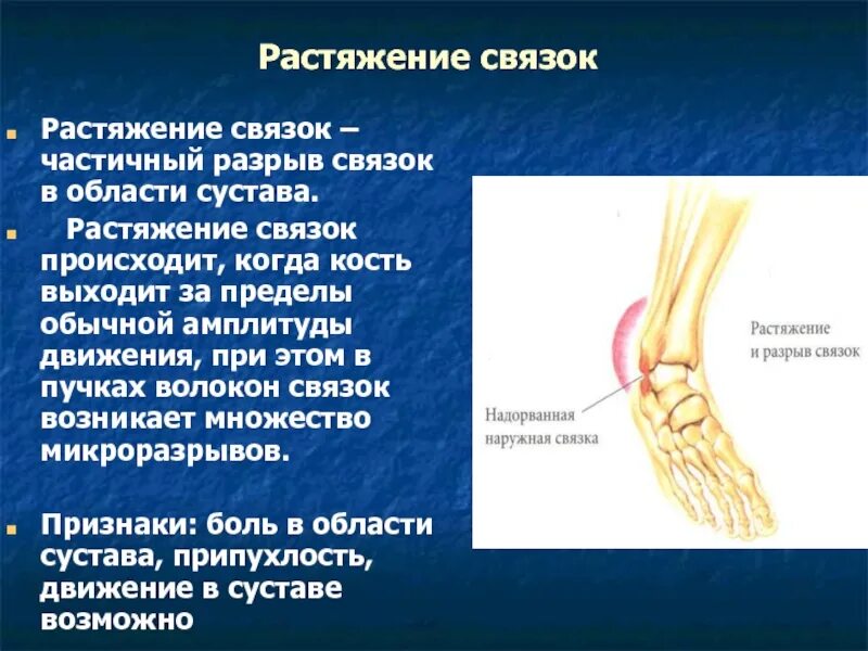 Растяжение связок сустава мкб