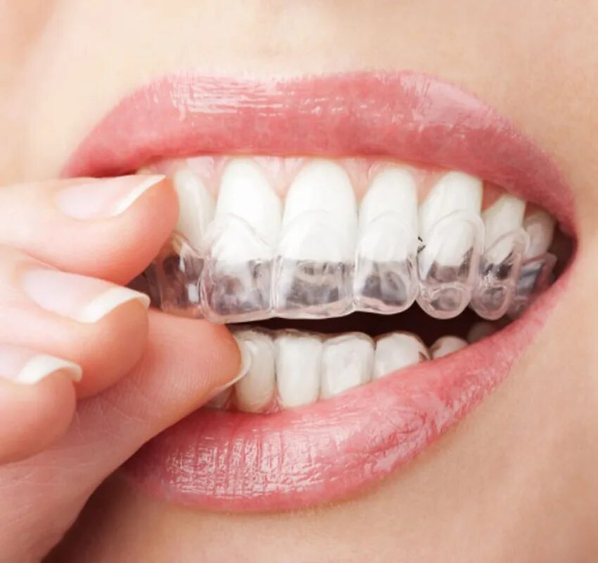 Альтернатива брекетам элайнеры. Элайнеры invisalign. Элайнеры star smile. Лайнеры зубные. Лайнеры зубные.