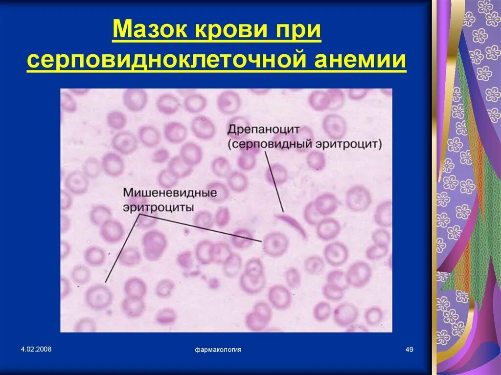 Серповидные эритроциты. Серповидноклеточная анемия картина крови. серповидно-клеточная анемия (s-гемоглобинопатия). серповидноклеточная анемия эритроциты. серповидноклеточная анемия мазок.