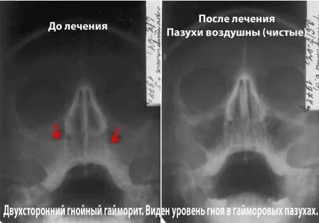 Двусторонний катаральный гайморит