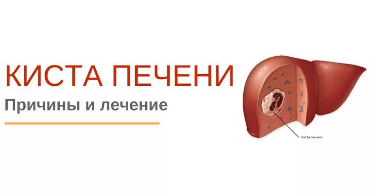 Как лечить кисту печени. Лекарство от кисты печени. киста печени причины возникновения.