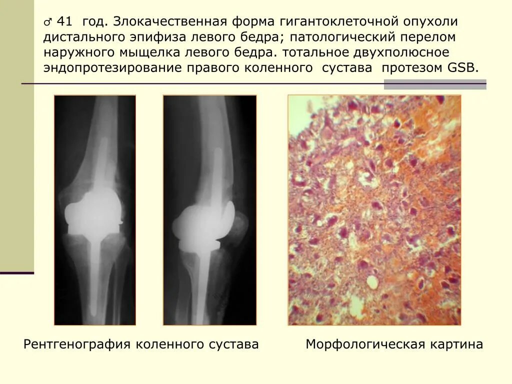 Гигантоклеточная опухоль большеберцовой кости рентген. Остеобластокластома большеберцовой кости рентген. Остеобластокластома большеберцовой кости. Гигантоклеточная опухоль лечение. Гигантоклеточная опухоль плечевой кости кт.