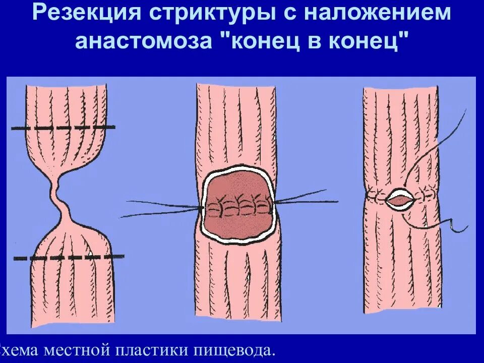 Наложение анастомоза конец в конец. Рубцовая стриктура анастомоза. Местная пластика пищевода.