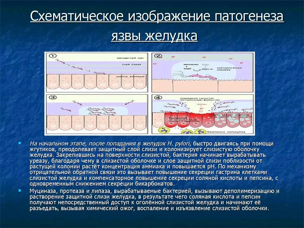 Патогенез язвенной болезни желудка. Патогенез язвы желудка и двенадцатиперстной кишки. Механизм образования язв. Механизм развития язвы желудка. Роль слизистых оболочек