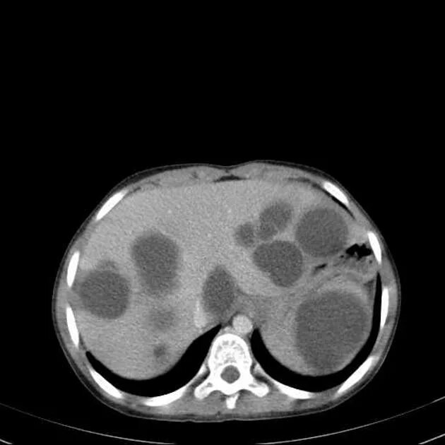 Киста печени мрт. Эхинококк печени кт картина. Эхинококк селезенки кт.