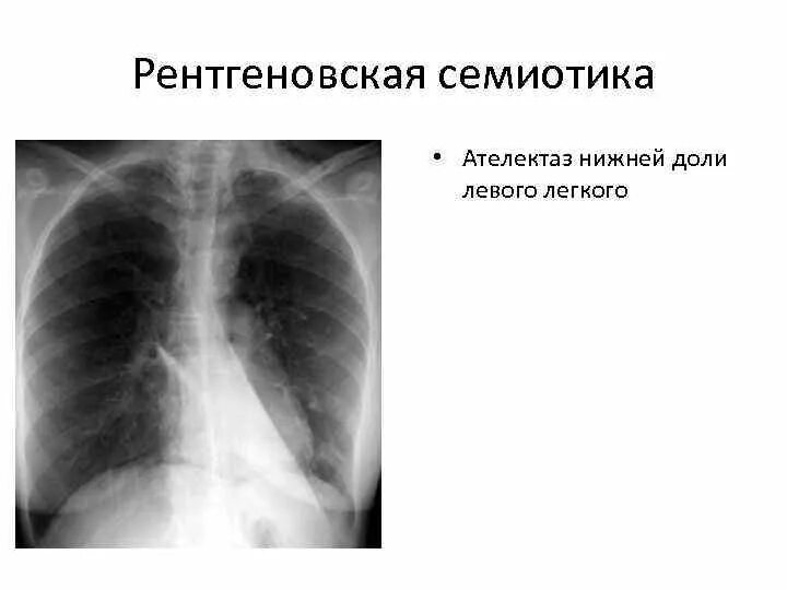 Ателектаз верхней доли рентген. Ателектаз правого легкого рентген. Ателектаз нижней доли легкого. Ателектаз нижней доли правого легкого рентген. Ателектаз нижнего легкого