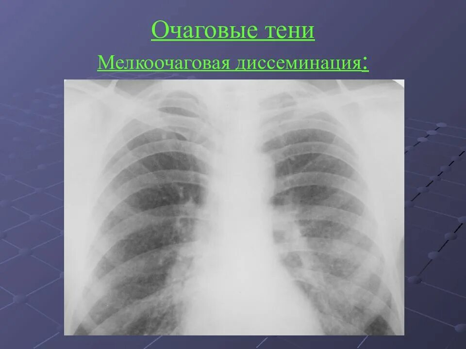 Очаговое поражение легких. Мелкоочаговая пневмония рентген. Очаговые тени в легких на рентгене. Метастазы легких рентгенодиагностика. Очаговые метастазы в легких.