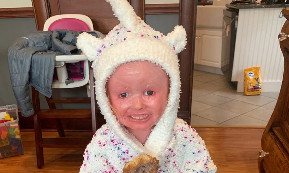 Ихтиоз арлекино у новорожденных. Ихтиоз синдром арлекина. Ихтиоз арлекина новорожденный. Дети арлекины. Майкл уинтер ихтиоз арлекина.