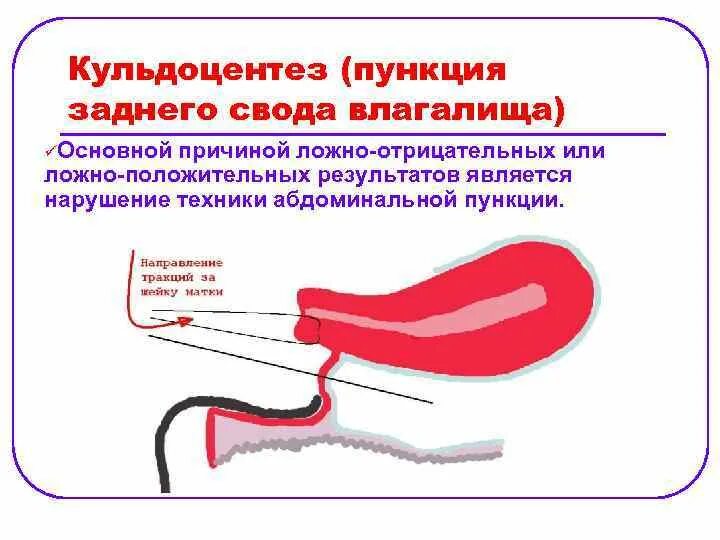 Пункция заднего свода брюшной полости. Пункция заднего свода показания. Пункция заднего свода в гинекологии показания. Пункция заднего свода влагалища (кульдоцентез). Пункция через задний свод