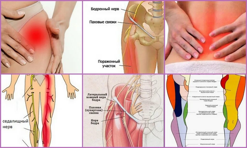 Нервы в области бедра. Нерв с внешней стороны бедра. Онемение бедра с наружной стороны. Болит наружная сторона бедра. Болит нога после уколов в ягодицу