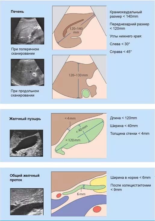 Плоскости сканирования печени при УЗИ. Как измерять печень на УЗИ. Печени размер краниокаудальный размер. Узи печени схема