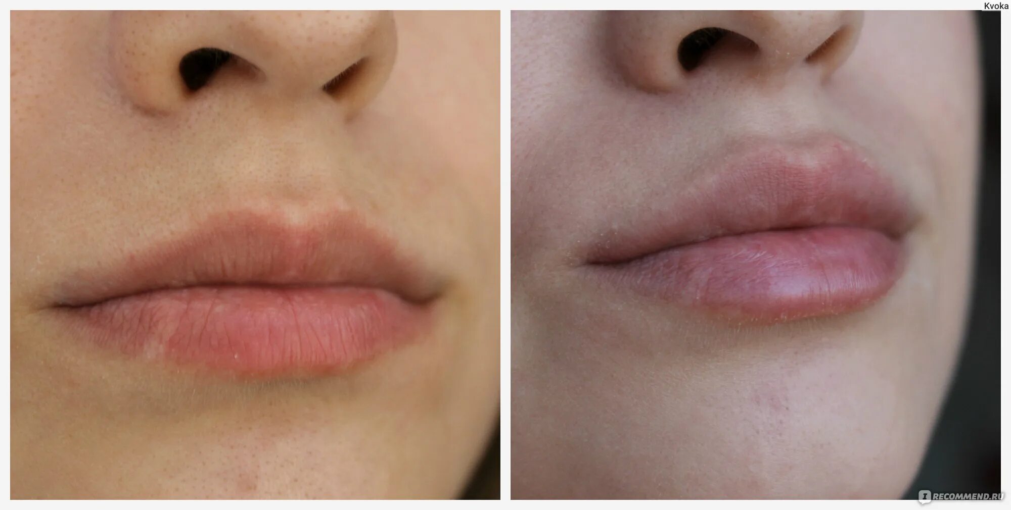 Увлажнение губ гиалуроновой кислотой 0.5 мл. 0.5 в губы до и после фото