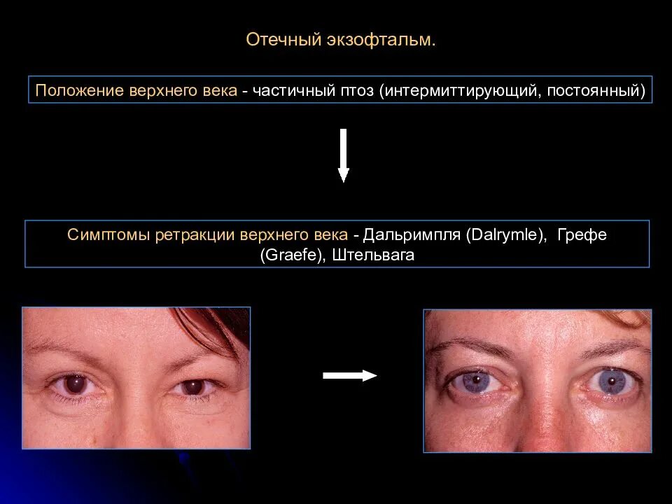 Экзофтальм наблюдается при. Эндокринная офтальмопатия птоз. Отечный экзофтальм патогенез.