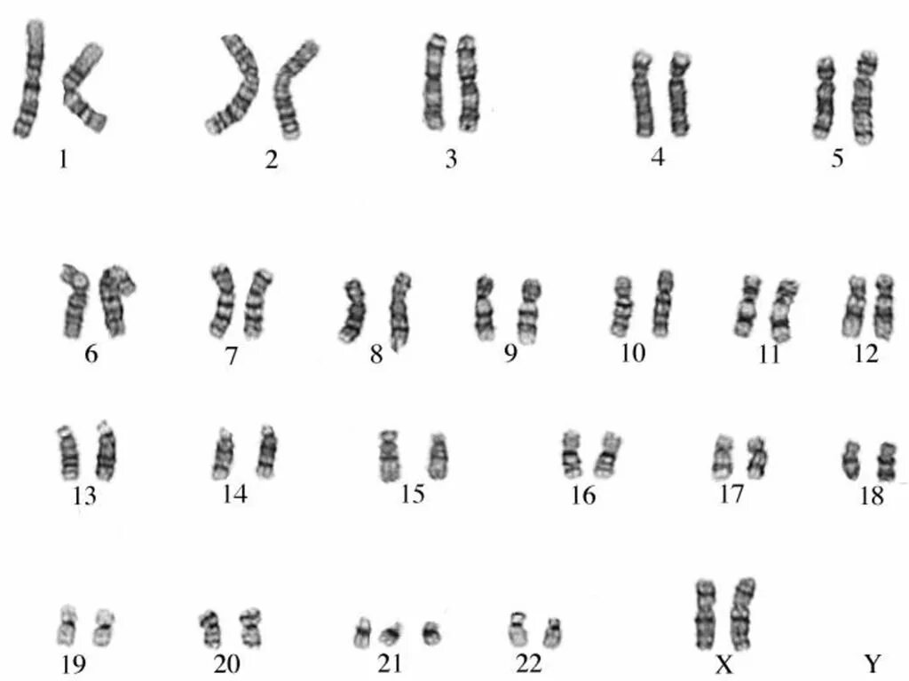 Пересадка хромосом. Фенилкетонурия кариотип больных. Трисомия по 21 хромосоме кариотип. Фенилкетонурия кариотип хромосом. Фенилкетонурия кариотип формула.