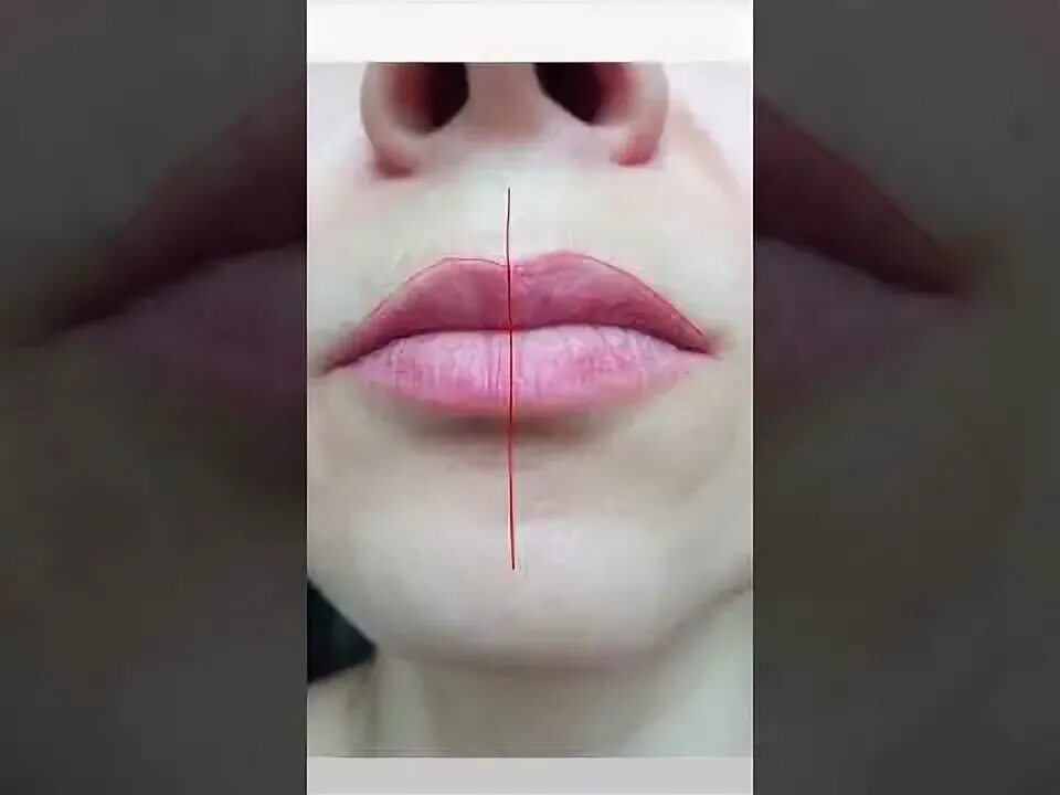 Исправить асимметрию губ фото до и после Warped: the inhabitant of Siberia received asymmetry of a mouth after increase i
