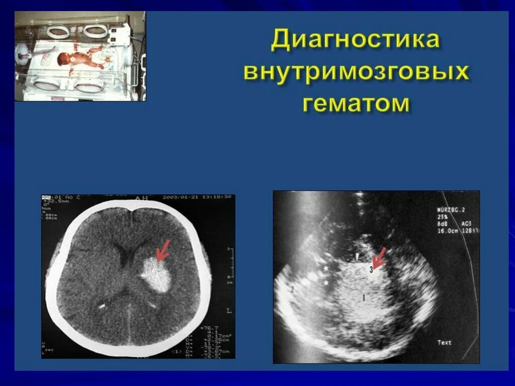 Недоношенный кровоизлияние. Внутрижелудочковое кровоизлияние. Внутричерепные кровоизлияния у новорожденных презентация. Кровоизлияние в мозг 1 степени у новорожденных. Внутрижелудочковое кровоизлияние кт.