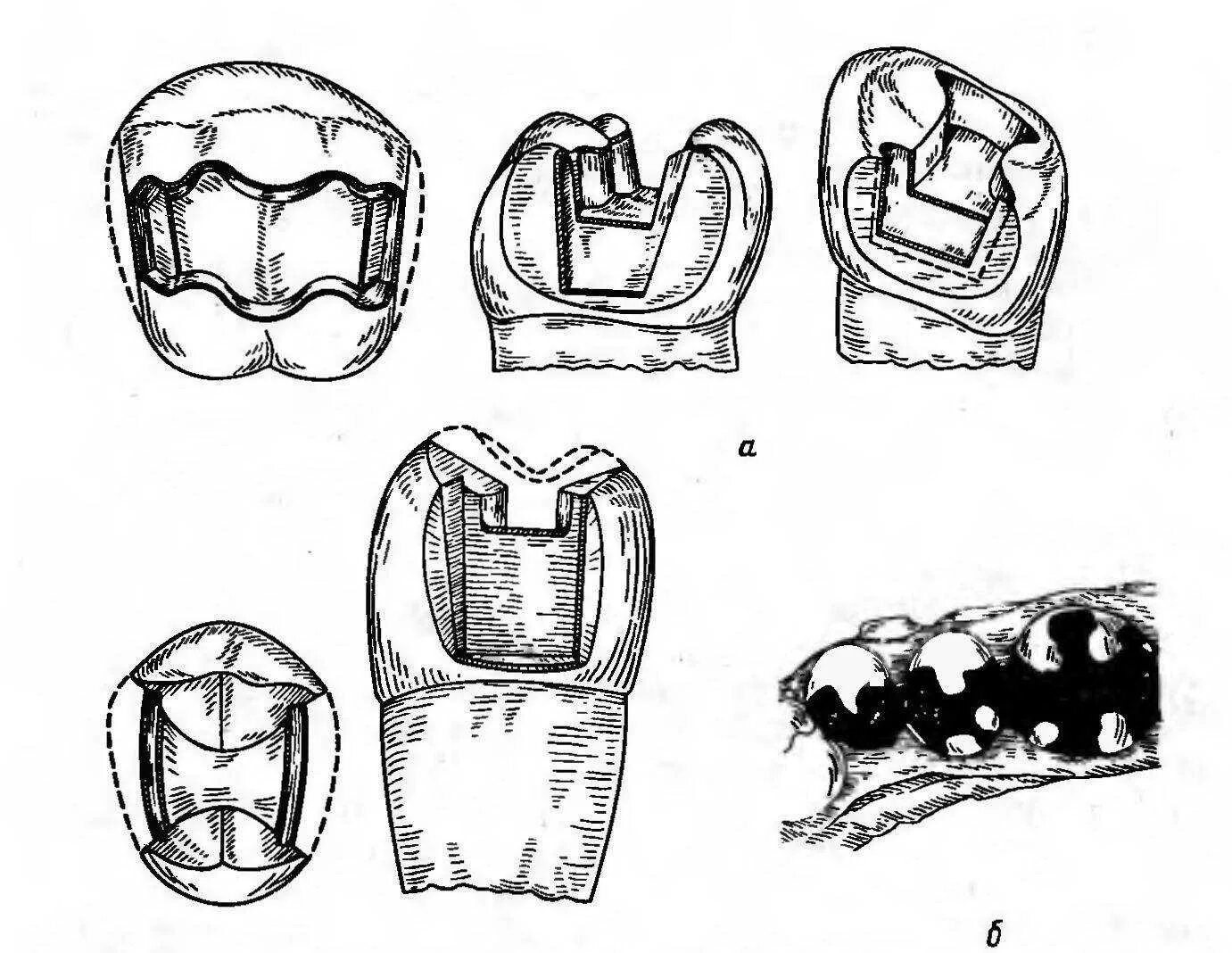 Культевые штифтовые вкладки лабораторные этапы. Клинико лабораторные этапы штифтовой вкладки. Лабораторные этапы культевой штифтовой вкладки. Клинико-лабораторные этапы изготовления вкладок. Штампованная коронка лабораторные этапы