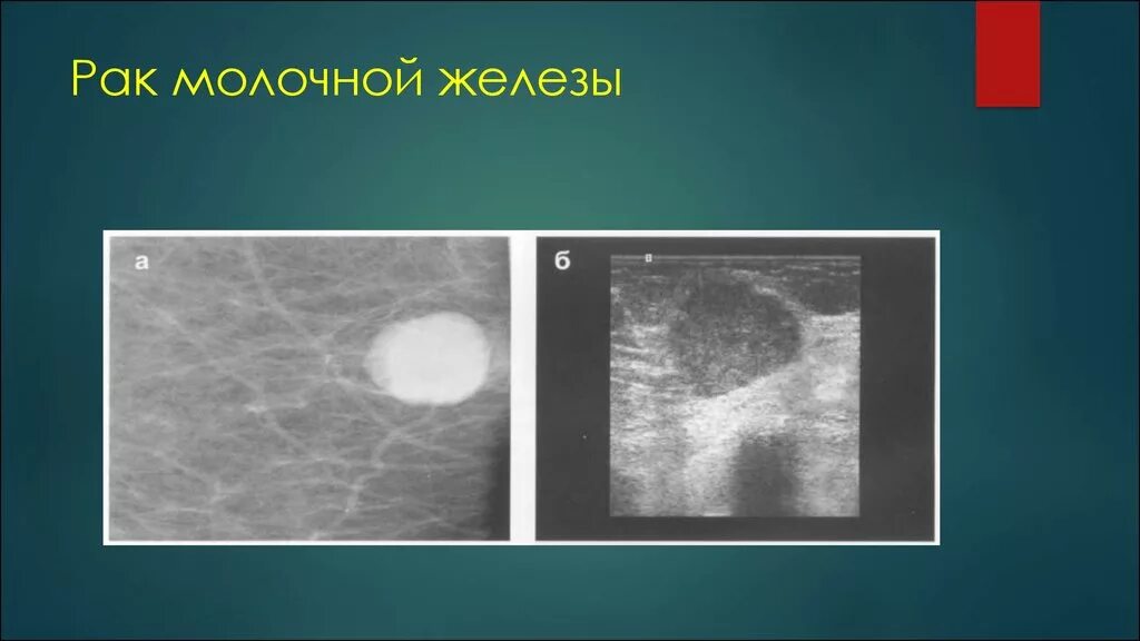 Доброкачественные опухоль снимок молочной железы. Доброкачественные новообразования молочной железы. Распадающаяся опухоль молочной железы. Рентгеновская диагностика заболеваний молочной железы. Доброкачественная железистая опухоль