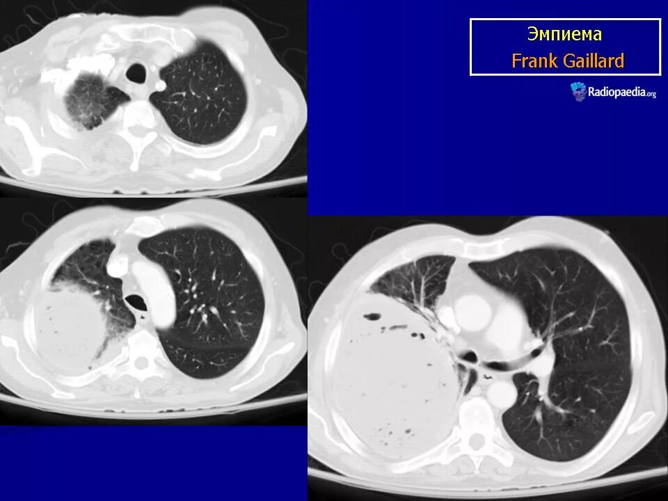 Эмпиема легкого. Осумкованная эмпиема плевры на кт. Осумкованный плеврит на кт легких.