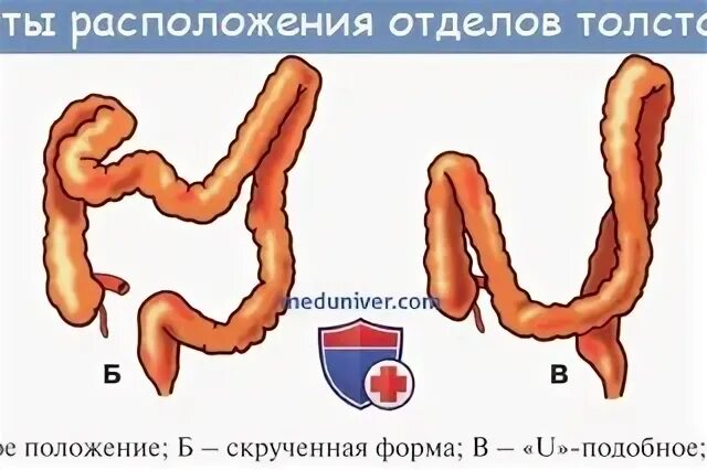Опущение задней стенки