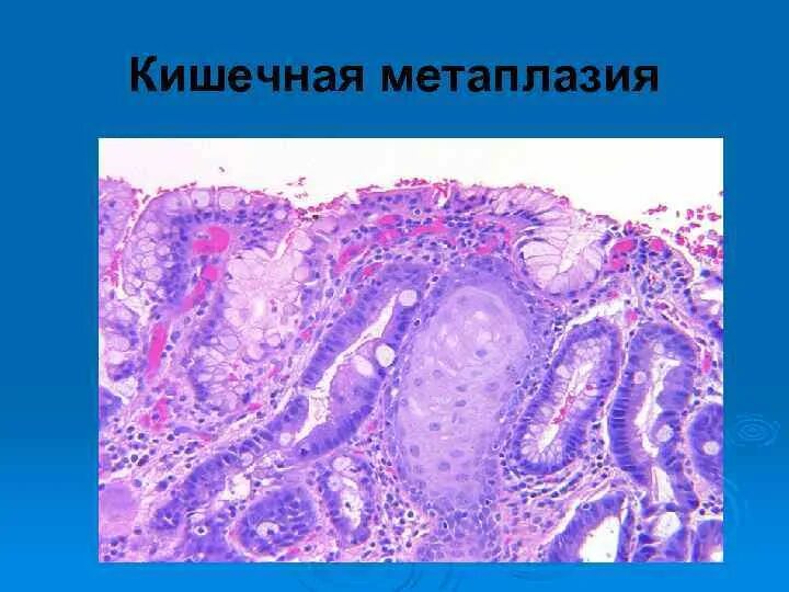 Метаплазия желудка гистология. Атрофический гастрит гистология. Кишечная метаплазия желудка гистология. Тонкокишечная метаплазия гистология. Группы клеток метаплазированного