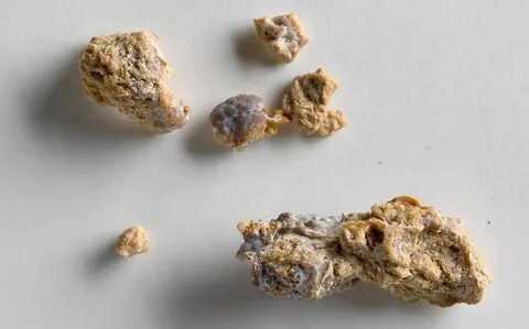 Мочекаменная болезнь: симптомы, причины, как избежать